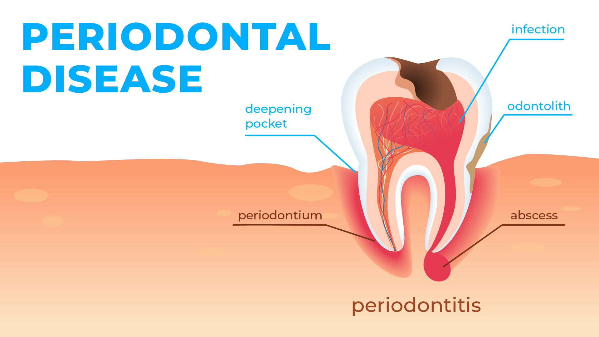 Periodontal Disease.